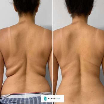 BeautyFix Medspa East side - Coolsculpting and Radiofrequency skin tightening, ONE session of each - Medical Spas Near Me - New York, New York BeautyFix Medspa East side - Coolsculpting and Radiofrequency skin tightening, ONE session of each - Medical Spas Near Me - New York, New York