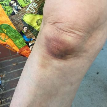 Erewhon - My knee after slipping in a puddle at Erewhon Calabasas (8/19) - Grocery Near Me - Calabasas, California