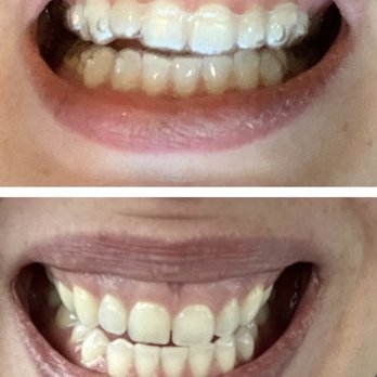 Justice Dental - Before and after. - General Dentistry Near Me - Lexington, Kentucky Justice Dental - Before and after. - General Dentistry Near Me - Lexington, Kentucky