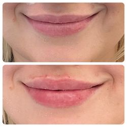 SkinLab Laser Aesthetics & Wellness - Lip Filler