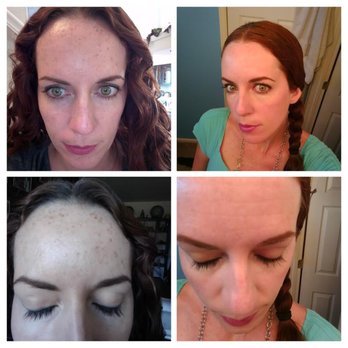 Hellenic Laser Spa - Before and After IPL - Laser Hair Removal Near Me - Denver, Colorado Hellenic Laser Spa - Before and After IPL - Laser Hair Removal Near Me - Denver, Colorado
