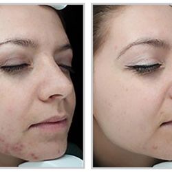 Luma MD Skin Rejuvenation - Sciton BBL Forever Clear
