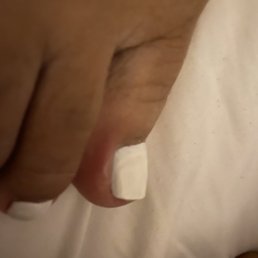 Swollen toe Swollen toe