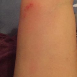 Plank Road Inn - bedbug bites just the wrist there were other locations