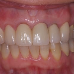 After smile makeover