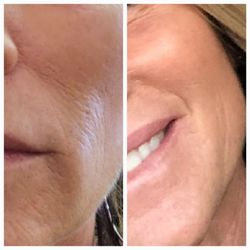 California Cryo - Skin Booster & Marine Liposomal COLLAGEN SUPPLEMENT