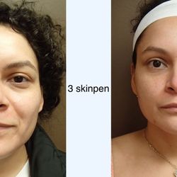 Timeless Plastic Surgery - 3 skinpen Microneedling sessions each performed 1 month apart.
