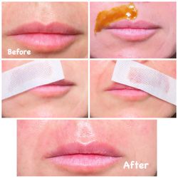 Brazilian Honey Waxing - Calabasas - Lip Honey Waxing