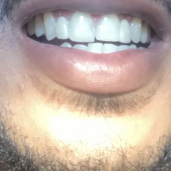 Hampden Dental Group - Two front teeth are different sizes - General Dentistry Near Me - Aurora, Colorado Hampden Dental Group - Two front teeth are different sizes - General Dentistry Near Me - Aurora, Colorado