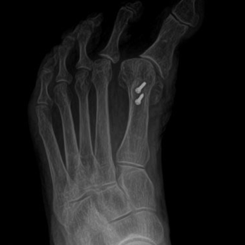 Jeffrey E McAlister, DPM, FACFAS - Bunions can be overdone - 1 of 2. Learn how at drjeffmcalister.com - Podiatrists Near Me - Scottsdale, Arizona Jeffrey E McAlister, DPM, FACFAS - Bunions can be overdone - 1 of 2. Learn how at drjeffmcalister.com - Podiatrists Near Me - Scottsdale, Arizona