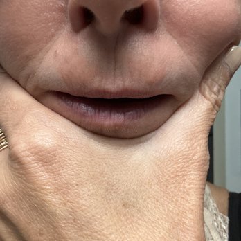 Be Bar MD - upper lip 450$ literally used a microscopic a nap amount of the filler. The rest was saline. - Medical Spas Near Me - Denver, Colorado Be Bar MD - upper lip 450$ literally used a microscopic a nap amount of the filler. The rest was saline. - Medical Spas Near Me - Denver, Colorado