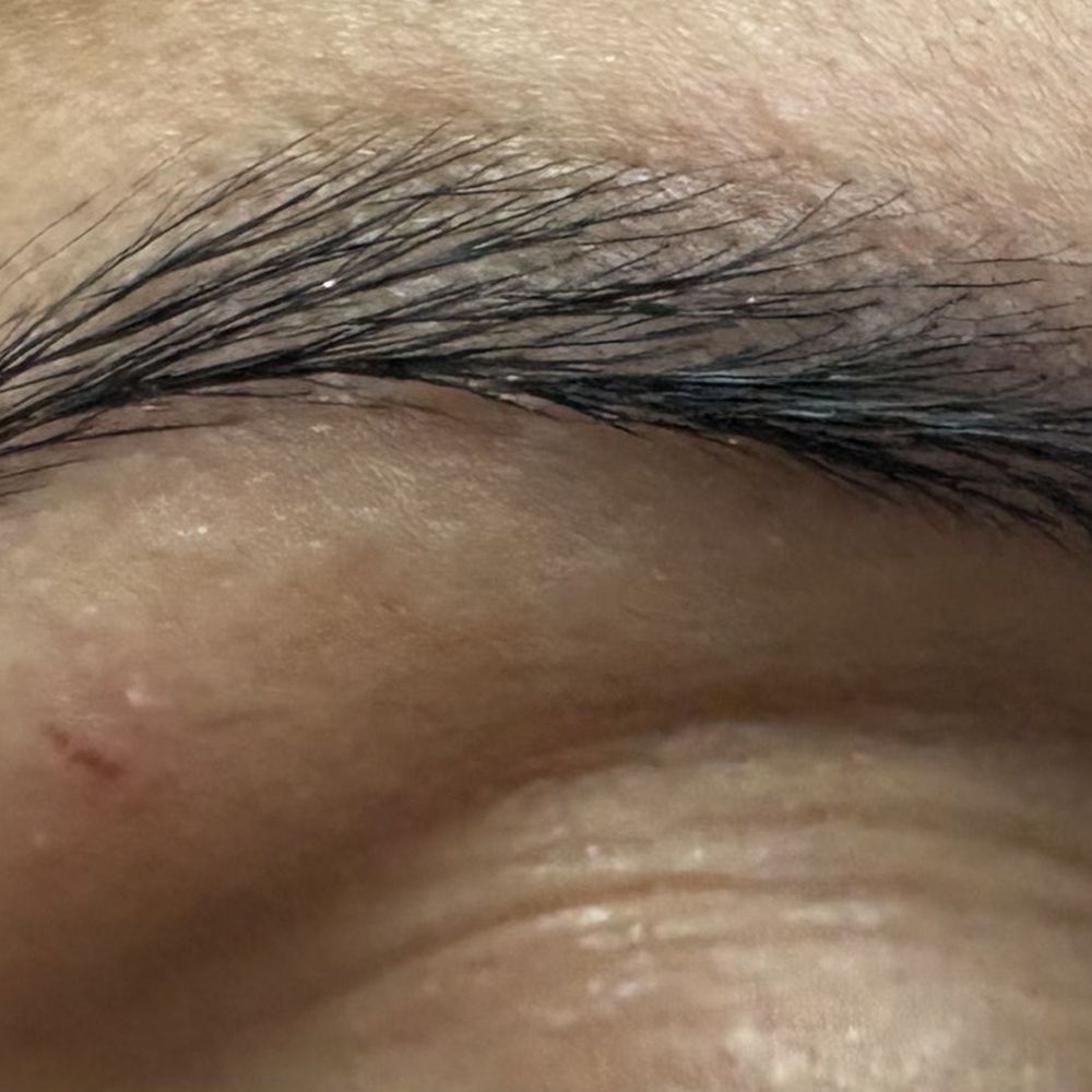 Eyebrow threaded (cut) next day with scabs