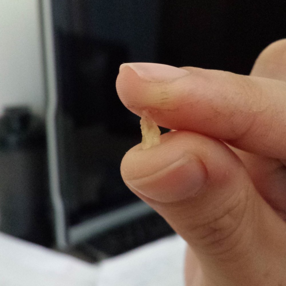 Anthony Wong, DDS - 1 of 3 pieces that fell out of my top right side. I felt stupid and played like a fool to come here. - Oral Surgeons Near Me - Anaheim, California Anthony Wong, DDS - 1 of 3 pieces that fell out of my top right side. I felt stupid and played like a fool to come here. - Oral Surgeons Near Me - Anaheim, California