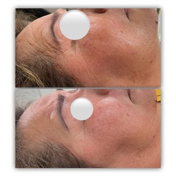 The Touch - Microneedling Before and After from One Session treatment - Skin Care Near Me The Touch - Microneedling Before and After from One Session treatment - Skin Care Near Me