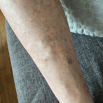 Texas Vascular Institute - One of the two veins still needing attention after a couple attempts. - Vascular Medicine Near Me - Dallas, Texas Texas Vascular Institute - One of the two veins still needing attention after a couple attempts. - Vascular Medicine Near Me - Dallas, Texas