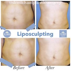 The Garden Medical Spa - Liposculpting