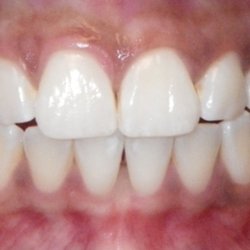 A List Smiles Orthodontics - BEFORE
