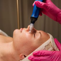 SkinPen Microneedling