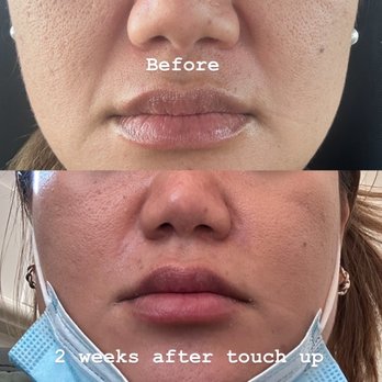 LaserAway - Smile lines were gone right away - Medical Spas Near Me - Dublin, California