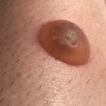 Haleh Bakshandeh, MD - Blister that showed up. I had no idea this procedure could cause a blister so I was horrified. - Dermatologists Near Me - Beverly Hills, California Haleh Bakshandeh, MD - Blister that showed up. I had no idea this procedure could cause a blister so I was horrified. - Dermatologists Near Me - Beverly Hills, California
