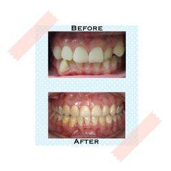 Huang T Anderson, DDS - Flushing - Before & After