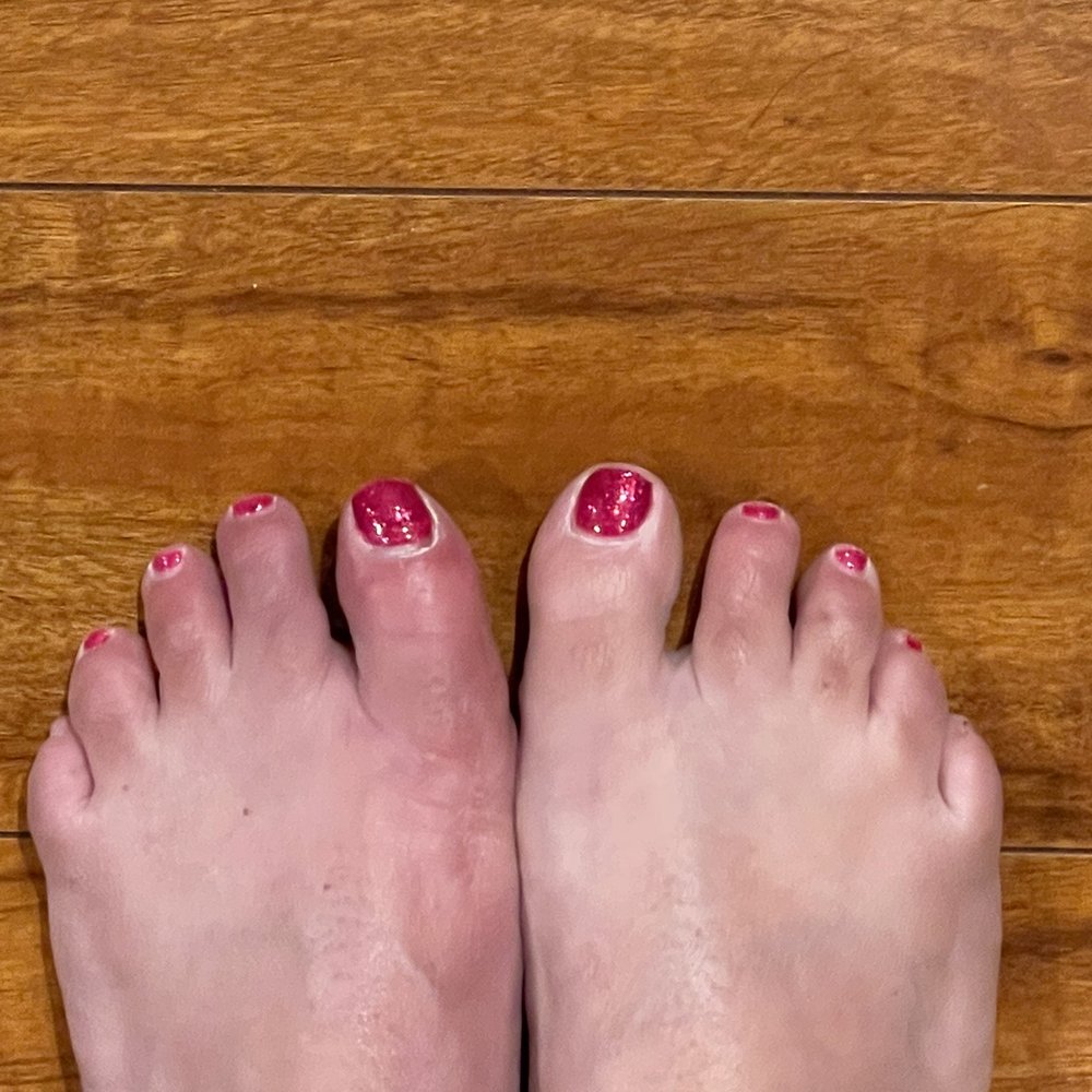 Before the nail came off. See how red the left big toe is. Before the nail came off. See how red the left big toe is.