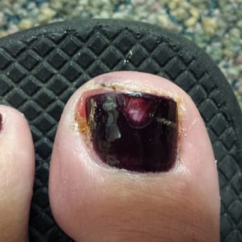 Tips & Toes Spa - I visited Tips & Toes and ended up with a bacterial infection in my toe. - Nail Salons Near Me - Fort Walton Beach, Florida Tips & Toes Spa - I visited Tips & Toes and ended up with a bacterial infection in my toe. - Nail Salons Near Me - Fort Walton Beach, Florida