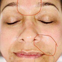 Skin Solutions by 2 Divas - After 1 st Microneedling... laugh lines disappeared on left and Other areas