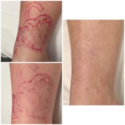 MEDermis Tattoo Removal  - 8 laser treatments for full removal