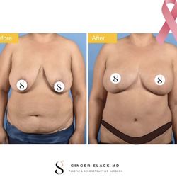 Ginger Slack, MD - DEIP flap reconstruction as part of prophylactic double mastectomy.