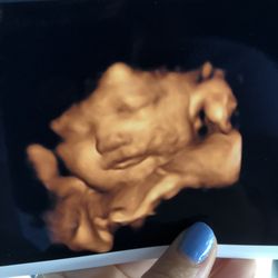 Heritage Baby View - Ultrasound photo