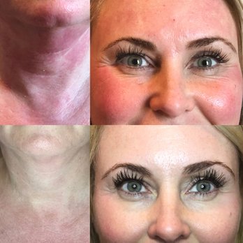 Saya's Esthetics - Microneedling 1 session. 3 weeks after - Skin Care Near Me - Tampa, Florida Saya's Esthetics - Microneedling 1 session. 3 weeks after - Skin Care Near Me - Tampa, Florida