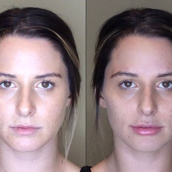 Vitality Medi Spa - Nurse Injector, Aundrea Trevors' client before and after. - Day Spas Near Me - Halifax, Nova Scotia Vitality Medi Spa - Nurse Injector, Aundrea Trevors' client before and after. - Day Spas Near Me - Halifax, Nova Scotia