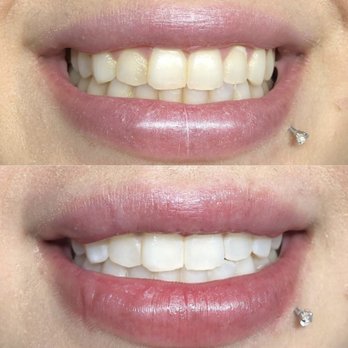 LYZA Beauty Bar - LED Teeth Whitening! Instant results - Makeup Artists Near Me - Modesto, California LYZA Beauty Bar - LED Teeth Whitening! Instant results - Makeup Artists Near Me - Modesto, California