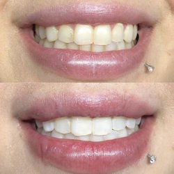 LYZA Beauty Bar - LED Teeth Whitening! Instant results