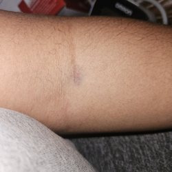 Labcorp - Bruising