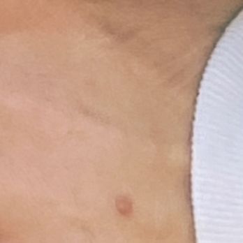 English Dermatology - Desert Ridge - My original wart - Dermatologists Near Me - Phoenix, Arizona