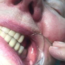 Daniel Bures, DDS - 3 Implant restorations providing a beautiful smile and enhanced chewing ability.