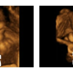Meet Your Miracle - An example of an ultrasound at every week!