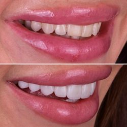 Dr. Michael Y. Jacobson - Robertson Dental Group - Natural looking porcelain veneers