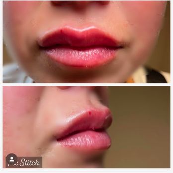 All About Aesthetics - Our results - IV Hydration Near Me - Rockwall, Texas
