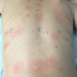 Brian K Greenberg, MD - Allergy testing.  Whatever gets inflamed is what he's allergic to.  My son is allergic to alot!  I'm so glad I learned this.