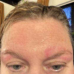 Kim's Nail Spa - The blisters I got because the girl refused to put aloe on my brows quickly.