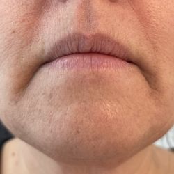 Elizabeth King Electrolysis - Client after 1 year (results may vary).