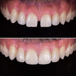 Dr. Michael Y. Jacobson - Robertson Dental Group - Minimal prep porcelain veneers , only 4 teeth