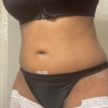 Sinno Center for Plastic Surgery - 2 weeks post op - Medical Spas Near Me - Ellicott City, Maryland Sinno Center for Plastic Surgery - 2 weeks post op - Medical Spas Near Me - Ellicott City, Maryland