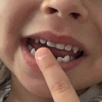 Capital Pediatric Dentistry - The amazing result! - Pediatric Dentists Near Me - Sacramento, California