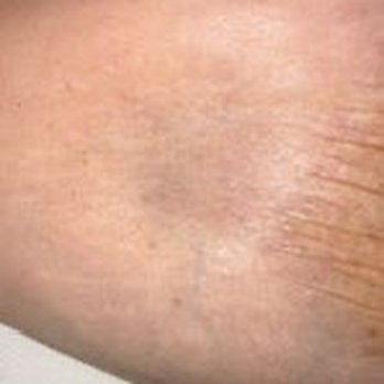 Ocean Drive Plastic Surgery - The dent in my right breast - Plastic Surgeons Near Me - Vero Beach, Florida