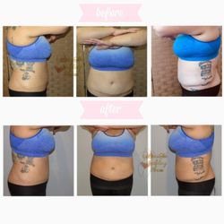 Beautee Sculpting House - A combination of ultrasonic cavitation and radio frequency was used to achieve the loss of inches as well as a sleeker abdomen.