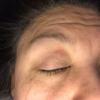 Forever Nails & Spa - My eye after the eye wax lady burned my eye lid and the tore off a layer of skin!!!! Most painful thing I have ever gone thru! - Skin Care Near Me - Valencia, California Forever Nails & Spa - My eye after the eye wax lady burned my eye lid and the tore off a layer of skin!!!! Most painful thing I have ever gone thru! - Skin Care Near Me - Valencia, California